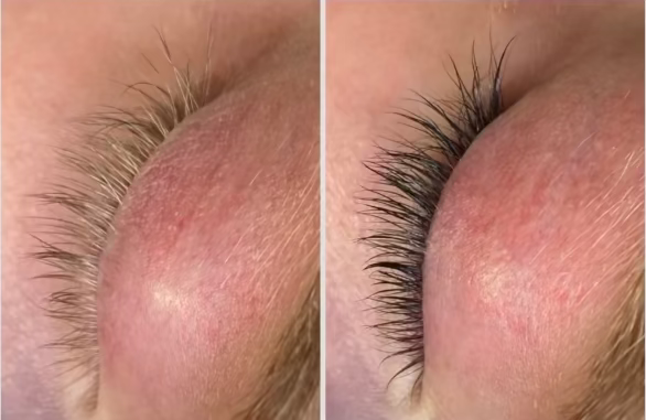 Close-up of an eye with a puffy eyelid and visible eyelashes.