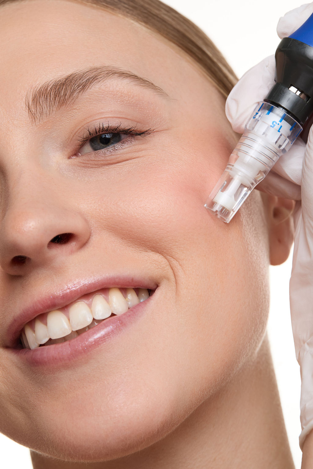 Close-up of a person receiving a SkinPen treatment on their face.